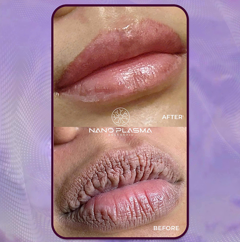 Công dụng của máy Plasma Monster Black
