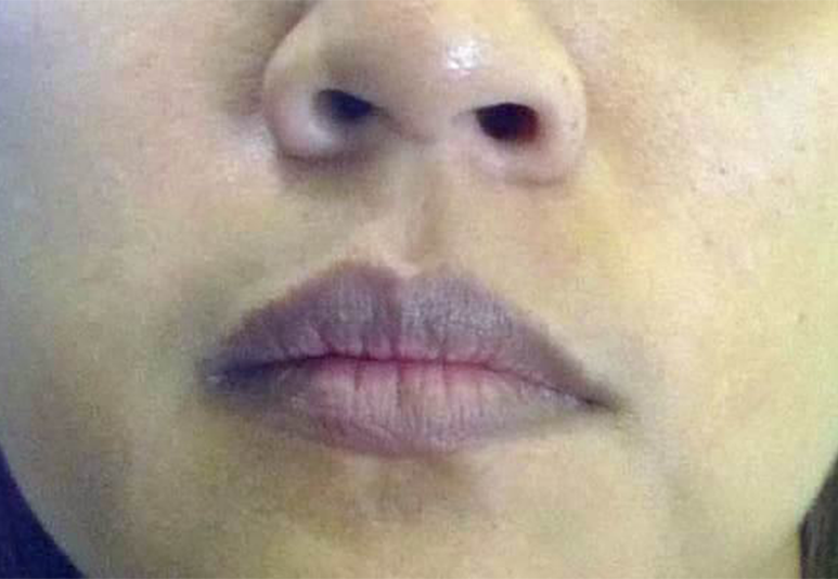 Hình ảnh môi thâm cần được xử lý