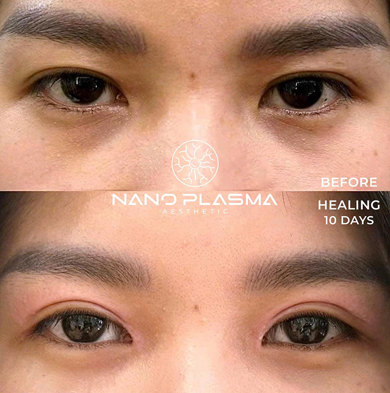 Nhấn mí bằng máy Plasma Beauty Monster Black